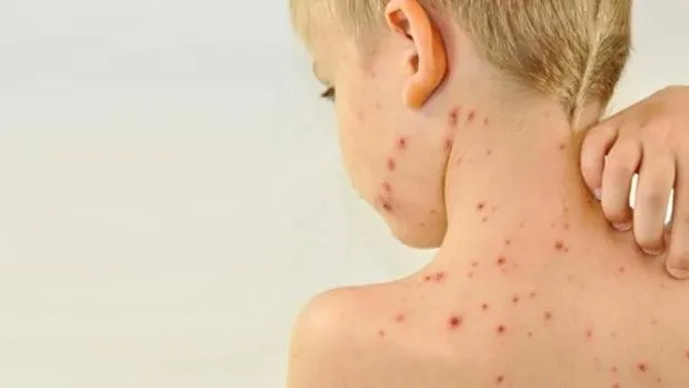 Imagen de archivo de un niño con sarampión / ABC