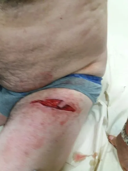 Foto 3 - El ataque de un jabal&iacute; deja importantes heridas al alcalde de Pi&ntilde;uel  