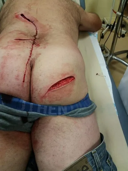 Foto 2 - El ataque de un jabal&iacute; deja importantes heridas al alcalde de Pi&ntilde;uel  