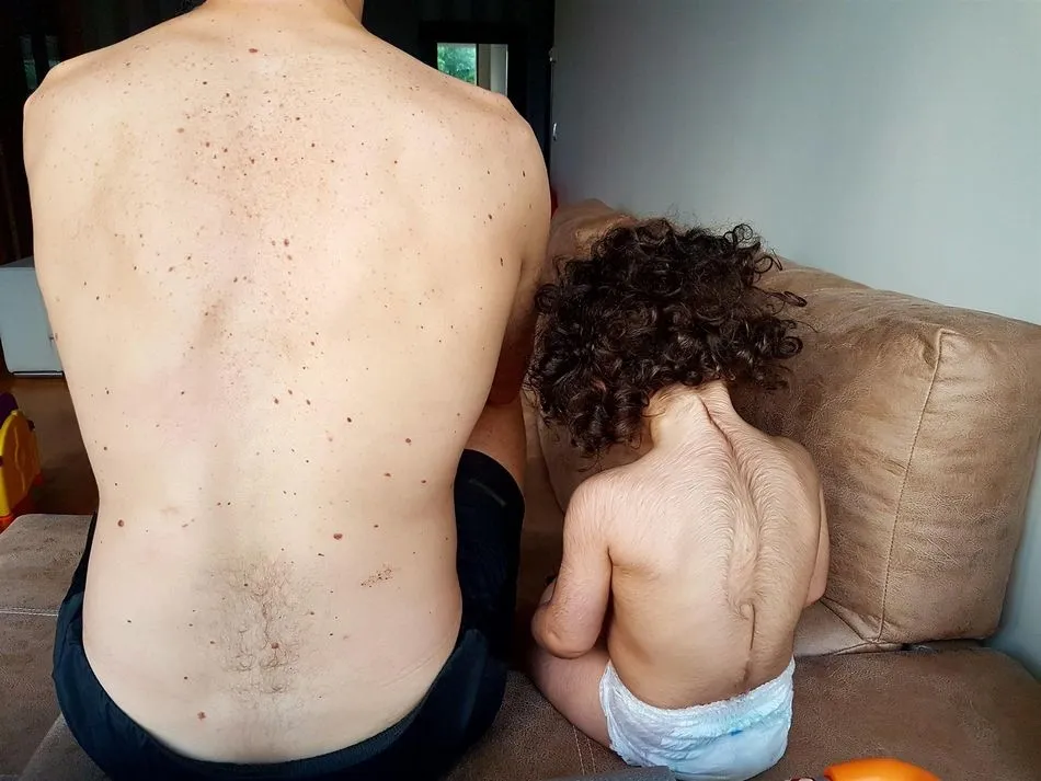 Más de 70 niños pueden estar afectados por el falso omeprazol  