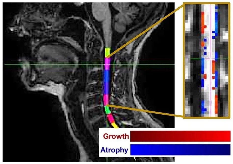 Desarrollan una nueva técnica que mide con mayor precisión la atrofia de médula espinal en...