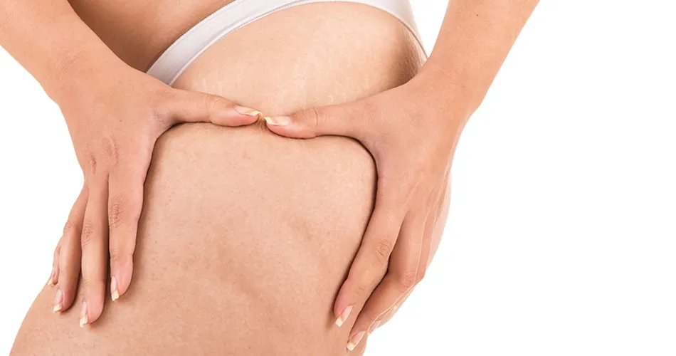 Cinco mitos sobre la celulitis que debes conocer