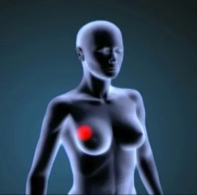 Hay al menos 190 genes que predisponen a padecer cáncer de mama