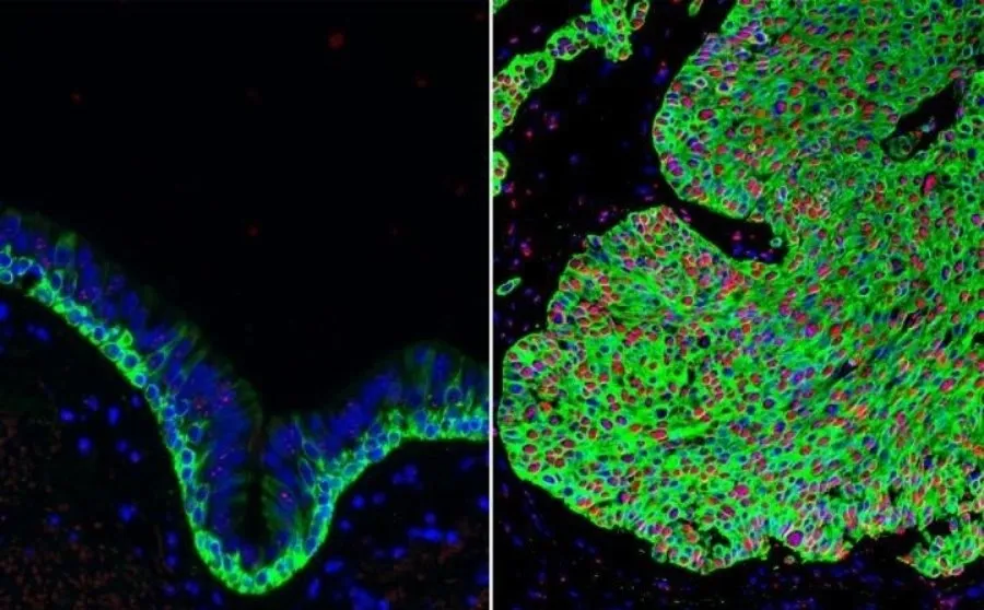 Tejido normal de las vías respiratorias (izquierda) y tejido canceroso del pulmón (derecha), con una sobreabundancia de células madre basales (verde). La forma activada de beta-catenina (rojo) en el cáncer de pulmón puede ser atacada por el compuesto. Fot