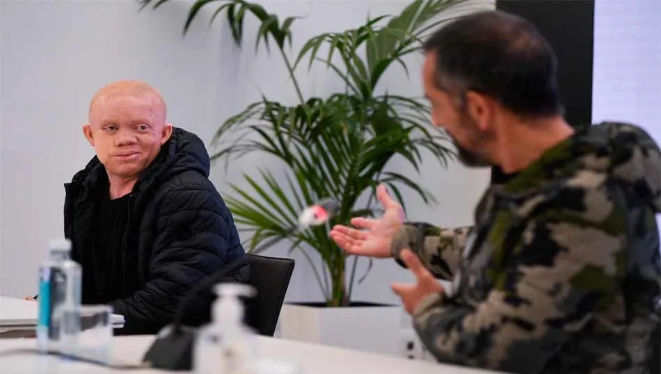 El joven albino guineano intervenido por Cavadas de un cáncer facial - JORGE GIL