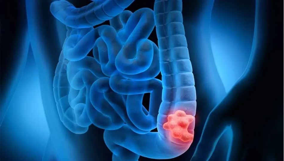 Experto advierte de que el 95% de los cánceres de colon tiene su origen en un pólipo  