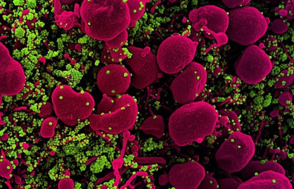 Micrografía electrónica de barrido coloreada de una célula apoptótica (rosa) muy infectada con partículas del virus SARS-COV-2 (verde), aislada de una muestra de un paciente