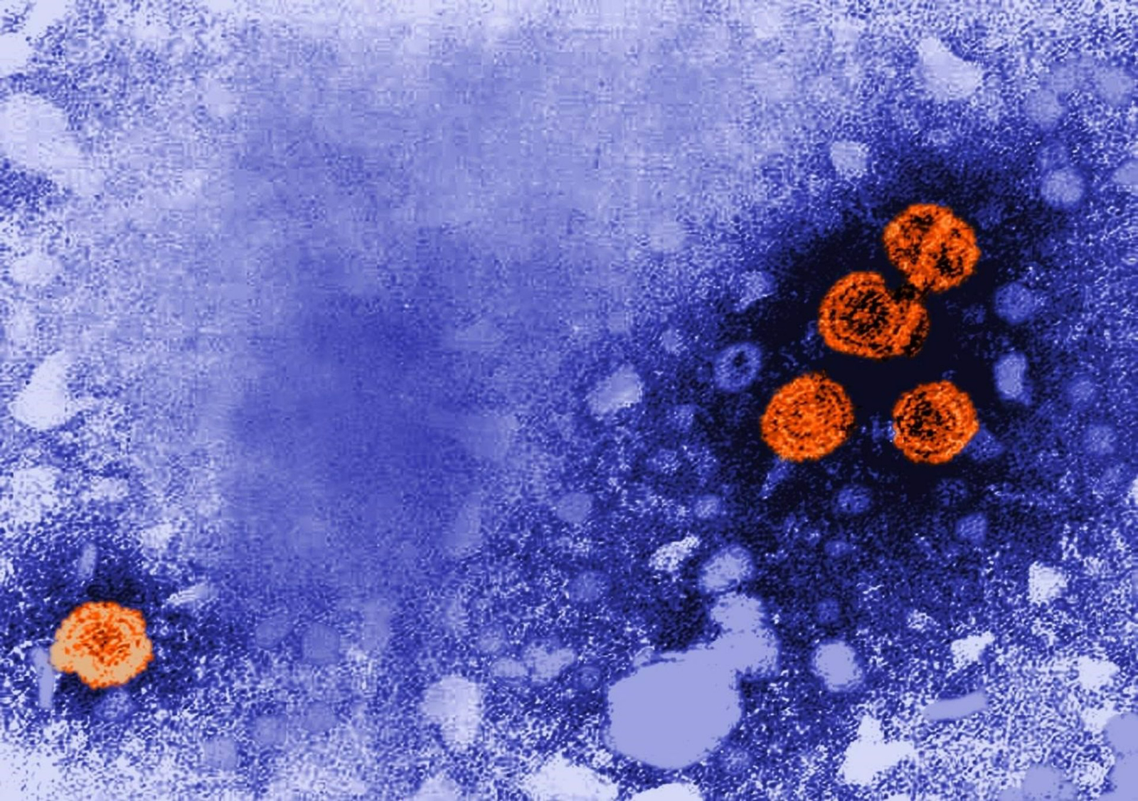 Imagen de microscopía electrónica de transmisión coloreada digitalmente revela la presencia de viriones de la hepatitis B (de color naranja) / EP