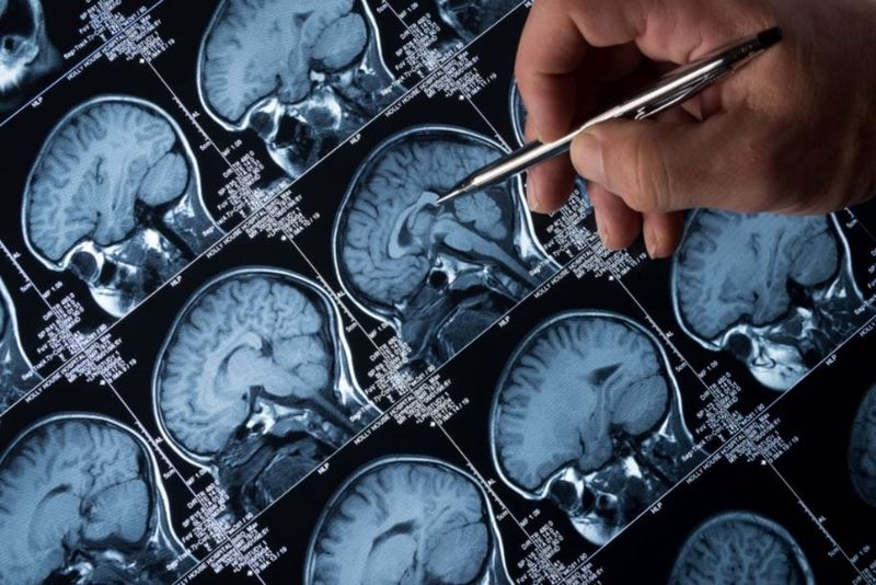 Foto 1 - Un fármaco con sello español muestra eficacia ante el tumor cerebral más frecuente