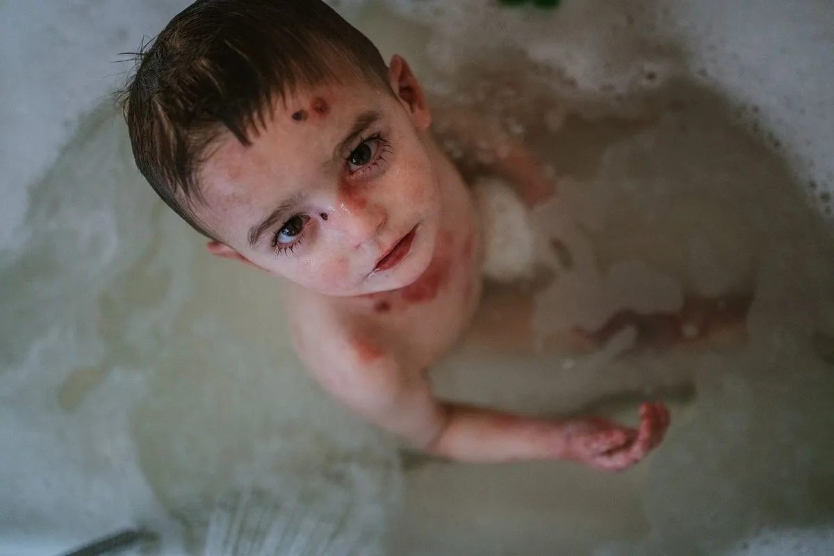 Javi, el pequeño salmantino de 4 años que convive con heridas abiertas por todo el cuerpo (Fotos: Martín Corradini)