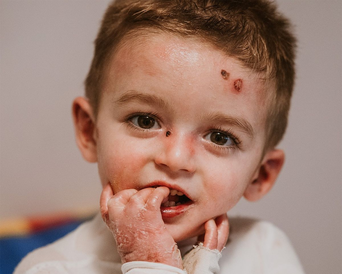 La esperanza de Javi, un salmantino de 4 años que convive con heridad abiertas por todo el cuerpo