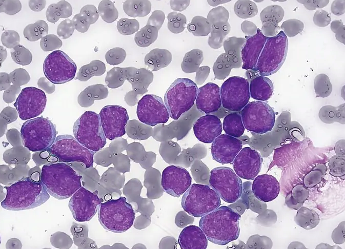 Leucemia infantil: Salamanca investiga cómo prevenirla