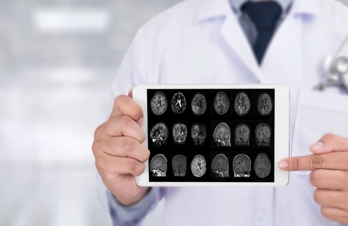 Identifican un mecanismo desconocido hasta ahora en la patogénesis de la enfermedad de Alzheimer  